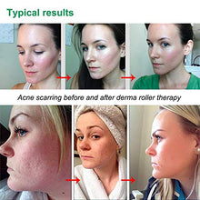 Carica l'immagine nel visualizzatore di Gallery, Anmyox Derma Roller Micro aghi Kit per viso e corpo, clear-green - Ilgrandebazar