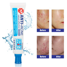 Carica l'immagine nel visualizzatore di Gallery, Acne Crema, Crema Anti Acne, Cicatrici Viso 30g - Ilgrandebazar