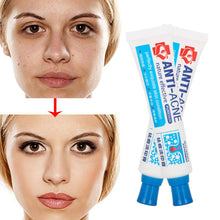 Carica l'immagine nel visualizzatore di Gallery, Acne Crema, Crema Anti Acne, Cicatrici Viso 30g - Ilgrandebazar