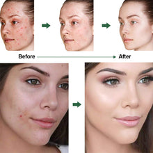Carica l'immagine nel visualizzatore di Gallery, Acne Crema, Crema Anti Acne, Cicatrici Viso... - Ilgrandebazar